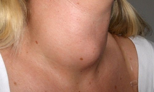 Mulher com pescoço inchado
