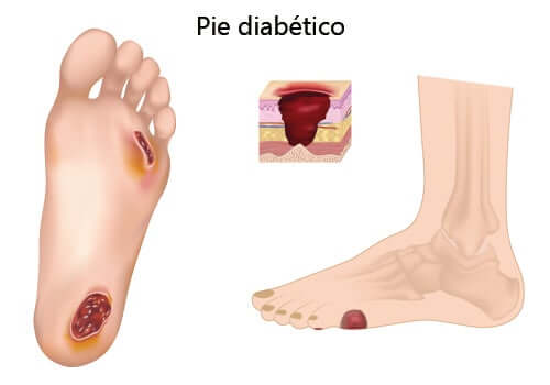 Como cuidar do pé diabético?