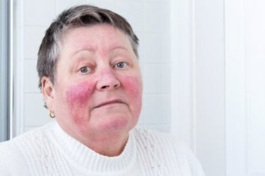 Causas e sintomas da rosácea
