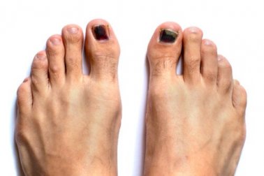 Unhas pretas nos pés: por que ocorrem e como tratá-las?