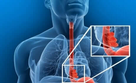 O que fazer diante de um corpo estranho esofágico?