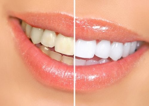 Dentes mais claros