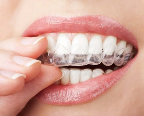 Clareamento dental