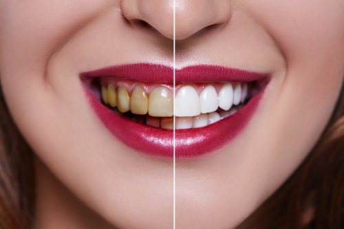 Clareamento dos dentes
