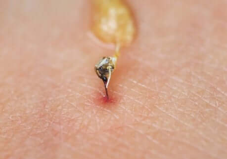 Como agir diante de uma picada de abelha