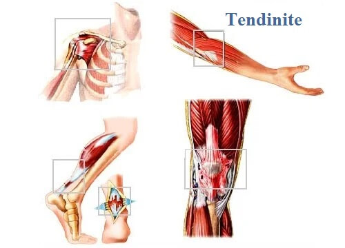 Tecido mole: locais comuns de tendinite