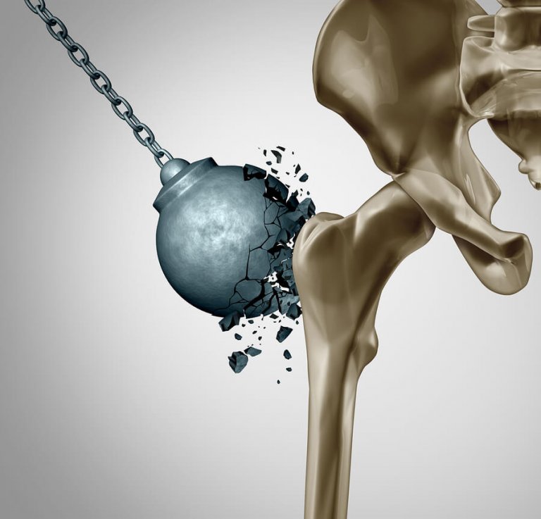 Como reduzir os danos da osteoporose após a menopausa