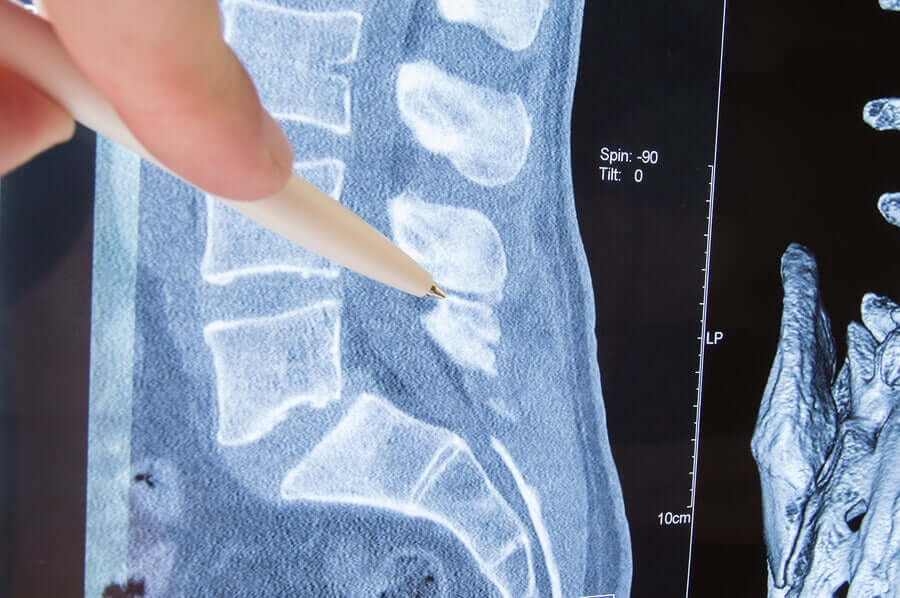 Radiculopatia: causas, sintomas e tratamento