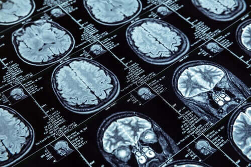 Ressonância magnética do cérebro