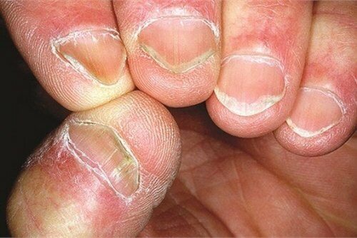 Unhas com síndrome de Hallopeau