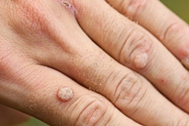 Tipos de verrugas e tratamentos