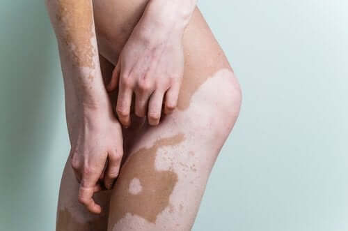 Como camuflar o vitiligo com maquiagem