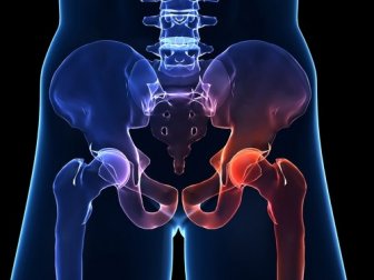 Osteoartrite do quadril: o que é e quais são os seus sintomas?