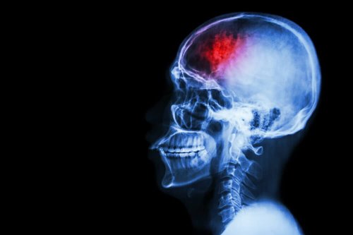 7 medidas preventivas contra o acidente vascular cerebral