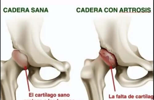 Osteoartrite do quadril