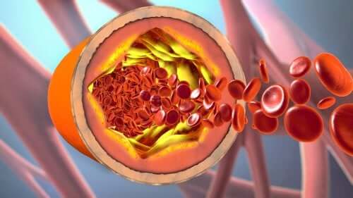 Arteriograma