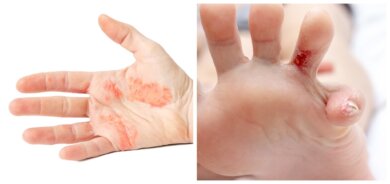 O que é disidrose palmar e plantar?