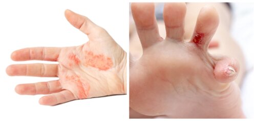 O que é disidrose palmar e plantar?