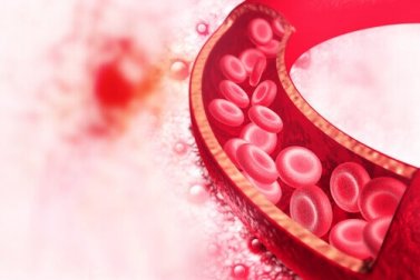 Displasia fibromuscular: diagnóstico e tratamento