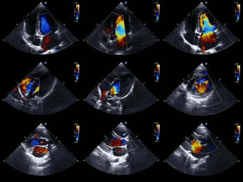 O ecocardiograma é um exame que pode detectar o derrame pericárdico