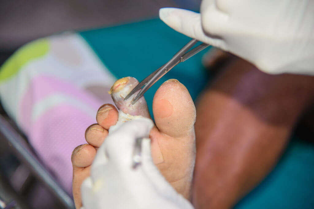 Gangrena diabética