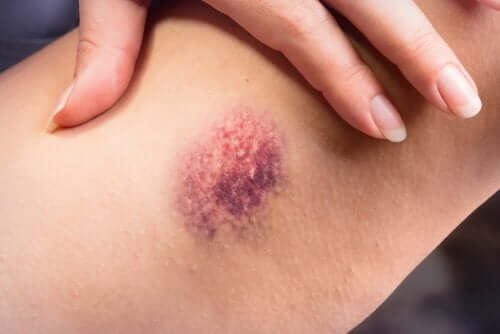 Hematoma característico da tromboflebite superficial