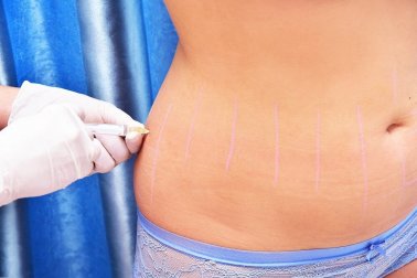 O que é e para que é usada a lipoterapia?