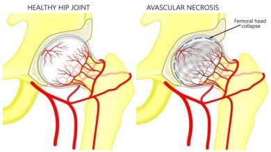 Necrose avascular da cabeça femoral