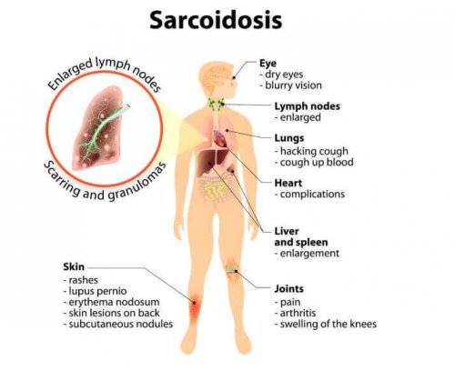 Sarcoidose: sintomas e tratamentos