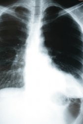Como a pneumonia afeta o corpo?