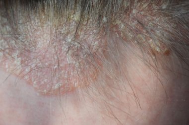 Psoríase no couro cabeludo: sintomas e tratamento
