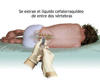 Punção lombar e dor de cabeça