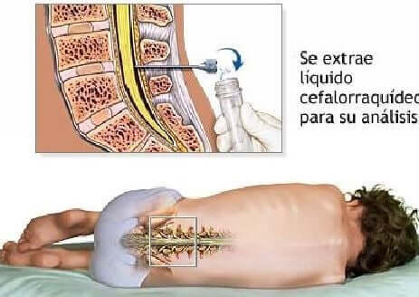 Punção lombar