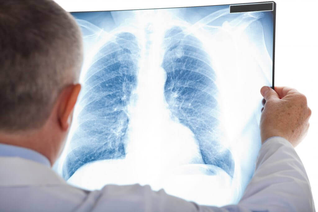 Radiografia dos pulmões