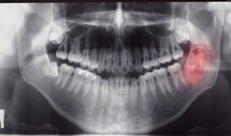 Diagnóstico de tumores e cistos mandibulares