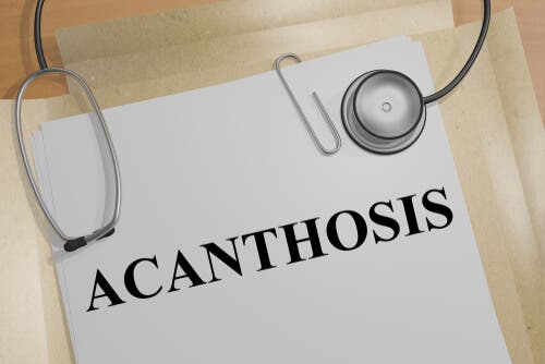 Tudo que você precisa saber sobre a acantose pigmentar