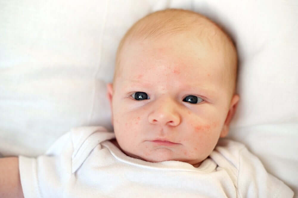 Bebê com acne neonatal