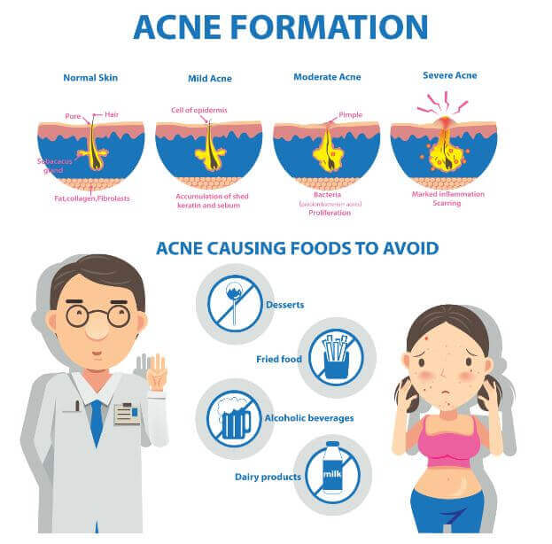 Formação da acne