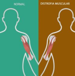 Doenças neuromusculares: sinais e sintomas