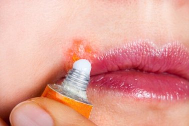 Sintomas do herpes labial e principais tratamentos