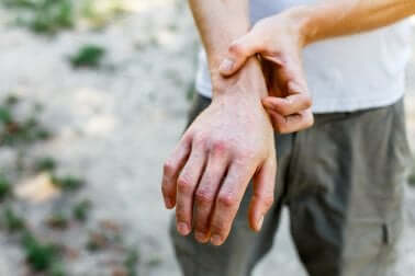 Homem com granuloma anular na mão