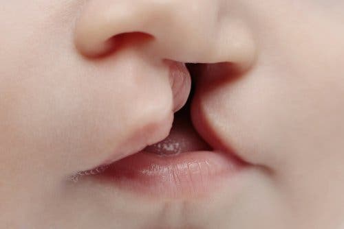 Bebê com lábio leporino