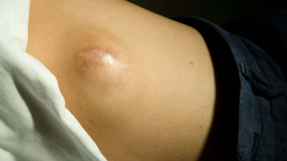 Lipoma no abdômen