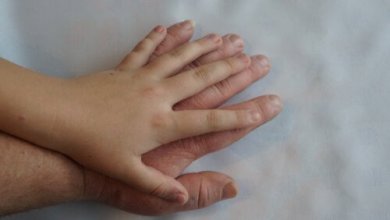 Acromegalia: o que é e quais são os seus sintomas?