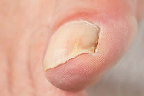 Micose nas unhas