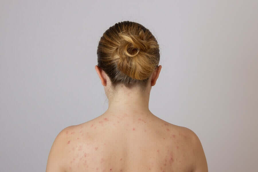 Mulher com acne nas costas