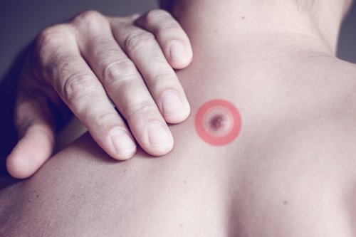 Nódulos de gordura nas costas: tudo que você precisa saber