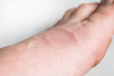 O que é o granuloma anular?