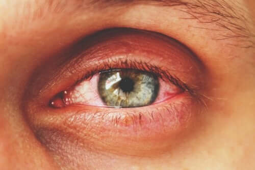 Olho com inflamação