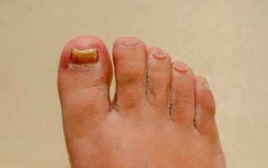 Remédios para a onicomicose nas mãos e nos pés